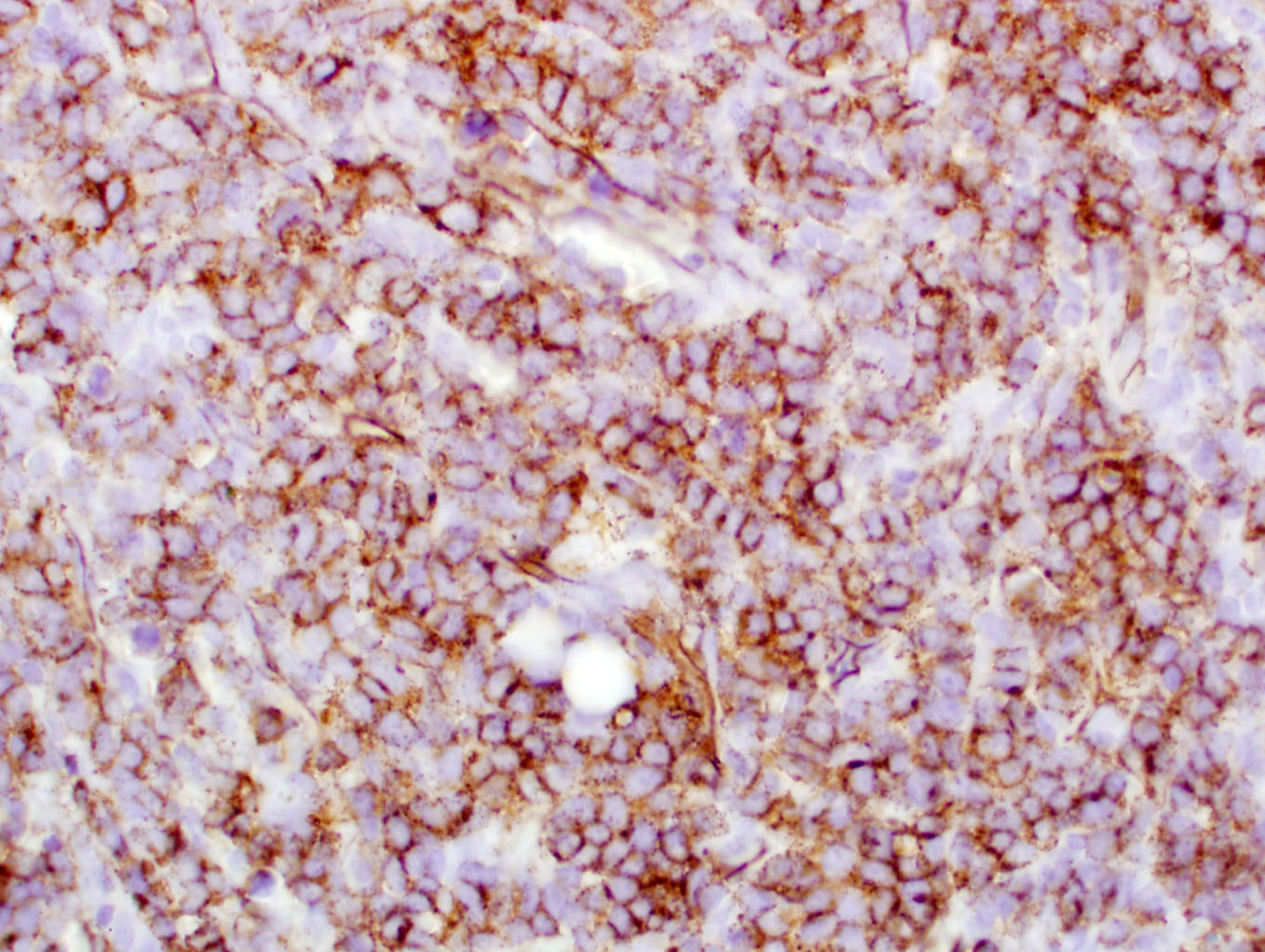CD34 staining of the neoplastic cells in the lymph node biopsy